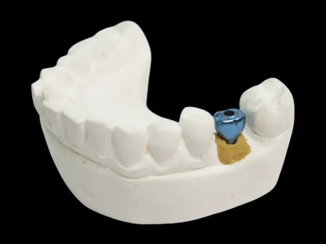 The Clinical and Esthetic Advantages of Custom Abutments — and Why Auraria Dental Ceramics Leads the Way in Denver
